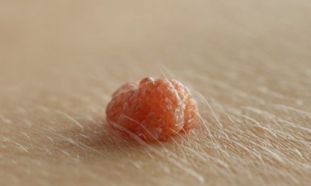 Papillome und Parasiten über Nacht loswerden: Sowjetischer Rat